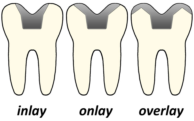 Differences between inlays, onlays, and overlays. 