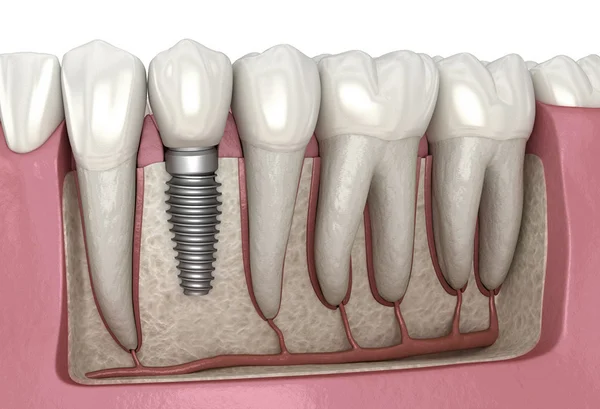 A dental implant could replace a lost tooth
