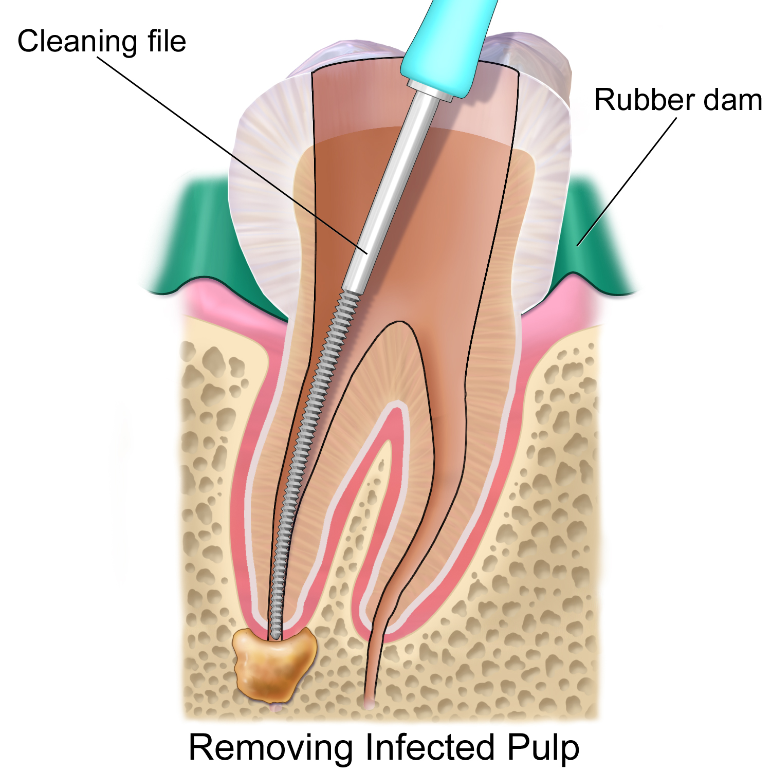 a root canal procedure may save your life from an infected tooth