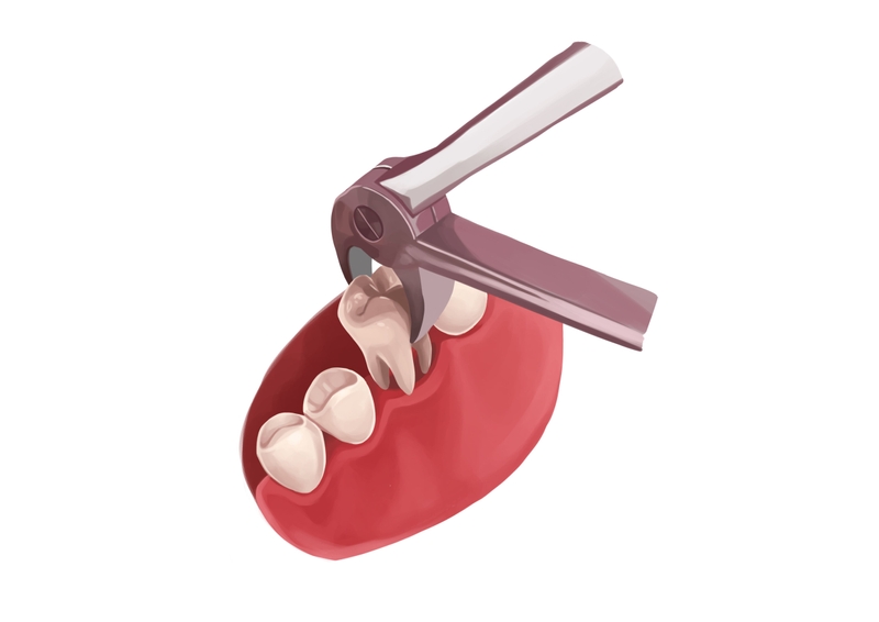 We offer tooth extraction