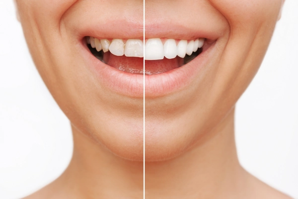 teeth whitening is offered at our clinic